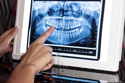 X-ray of patient's teeth
