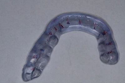 mouthguards for bruxism treatment